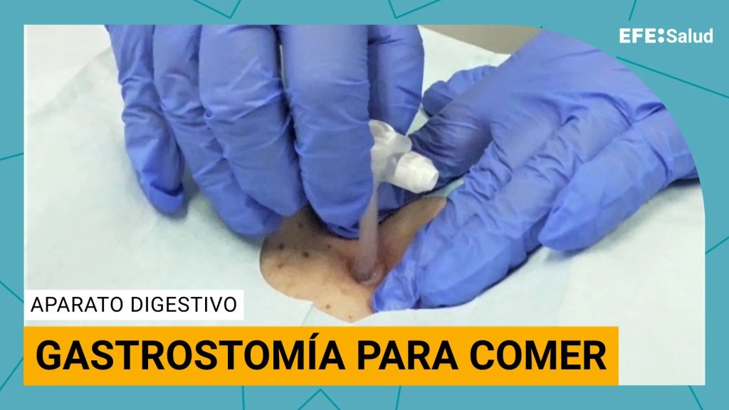 Gastrostomía.