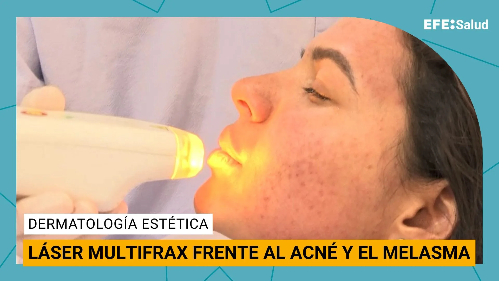 Acné y melasma.