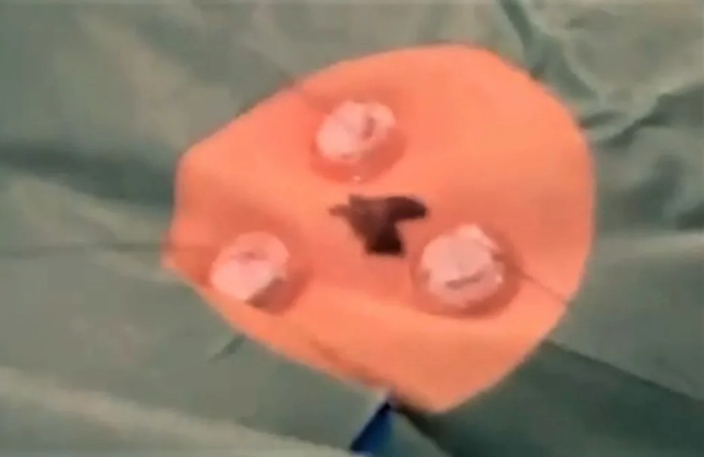 Gastrostomía con técnica de pexias.