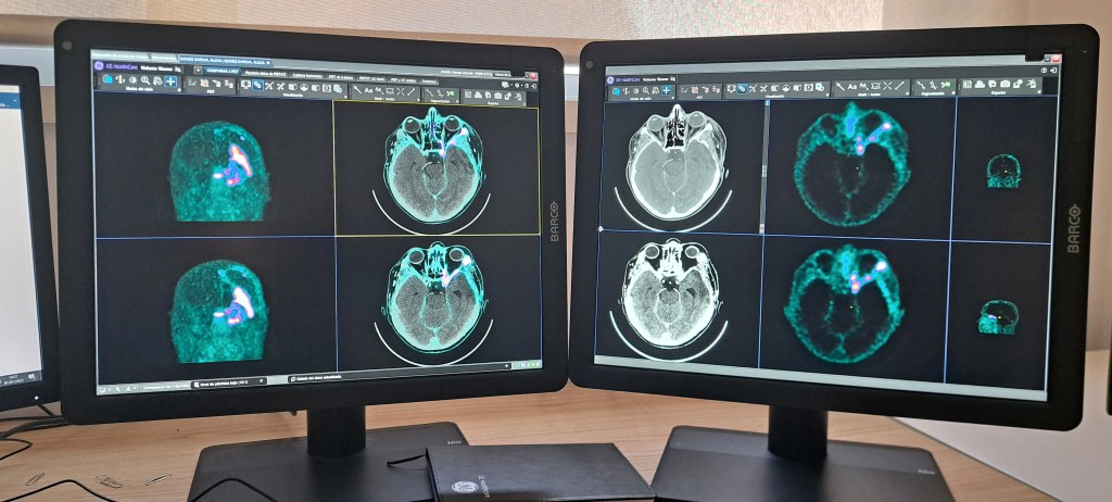 tumores cerebrales benignos