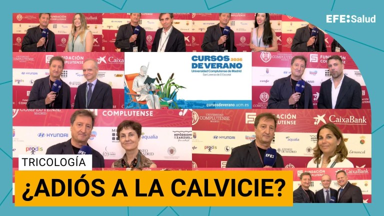 Calvicie común o alopecia androgenética.