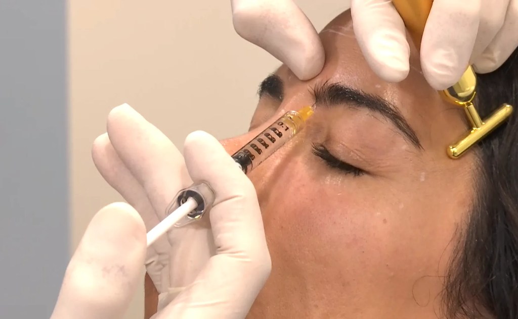Infiltración de bótox.