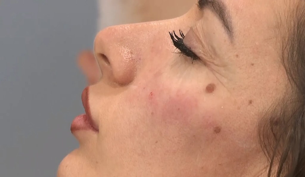 Tratamiento facial con ácido hialurónico.