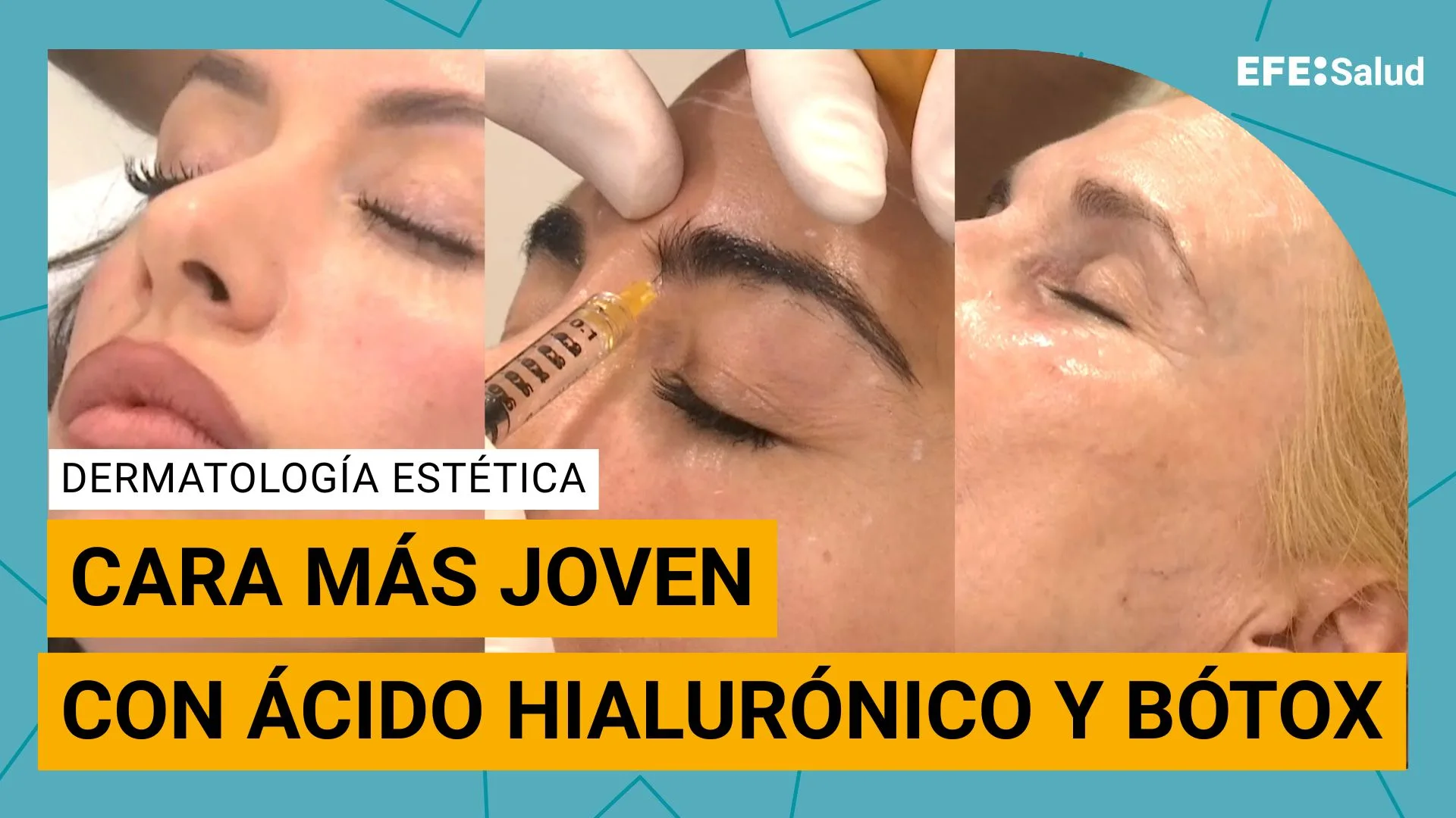 ácido hialurónico y bótox para embellecer la cara.