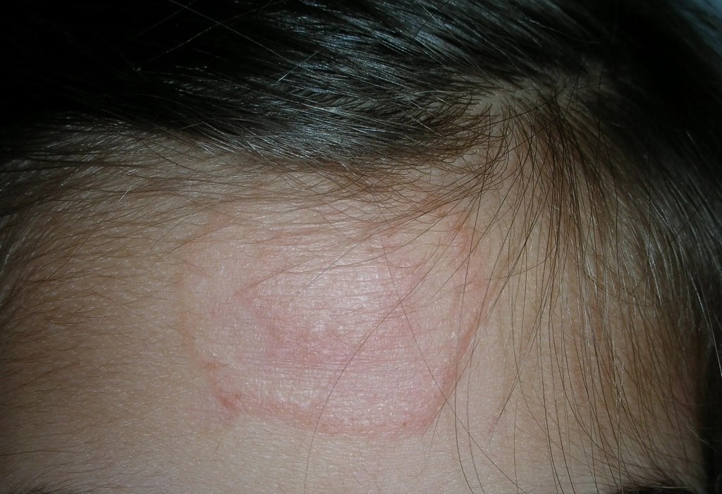 Deportes contacto tiña
