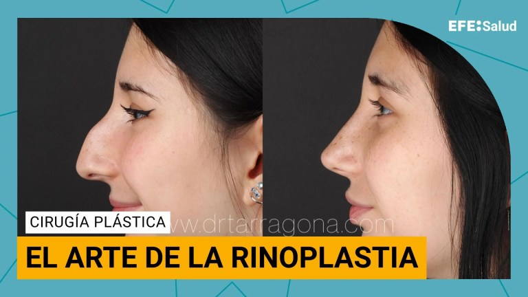 Rinoplastia