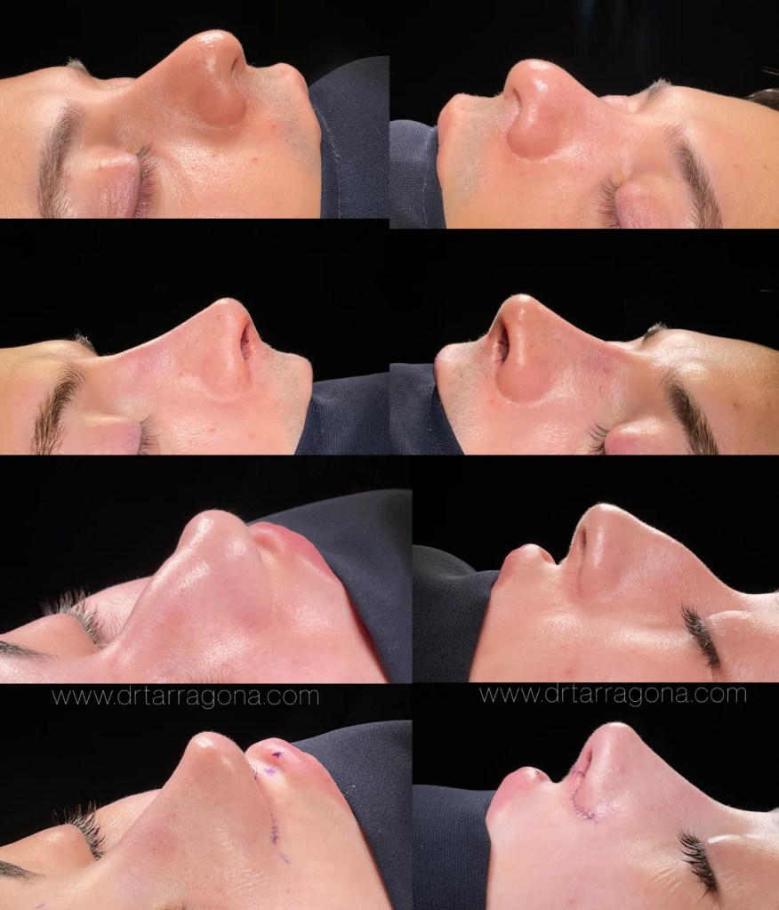 Rinoplastia en hombre y mujer