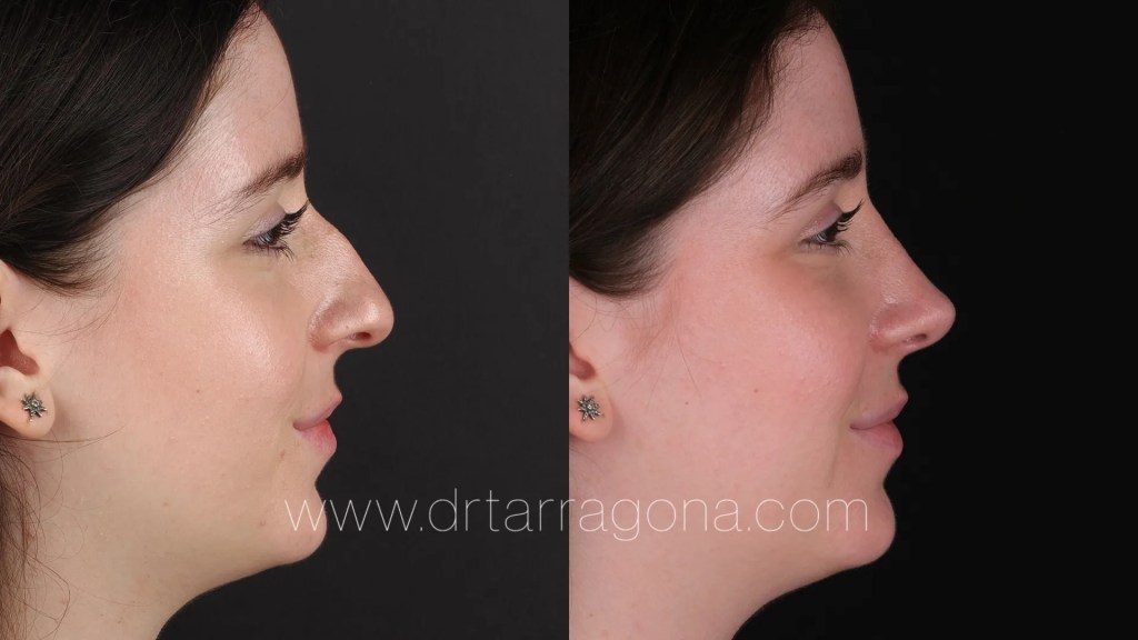 Rinoplastia de mujer.