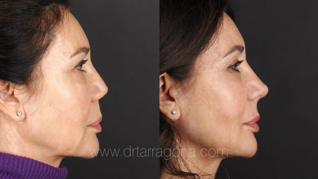 Mujer que se ha sometido a una rinoplastia secundaria.