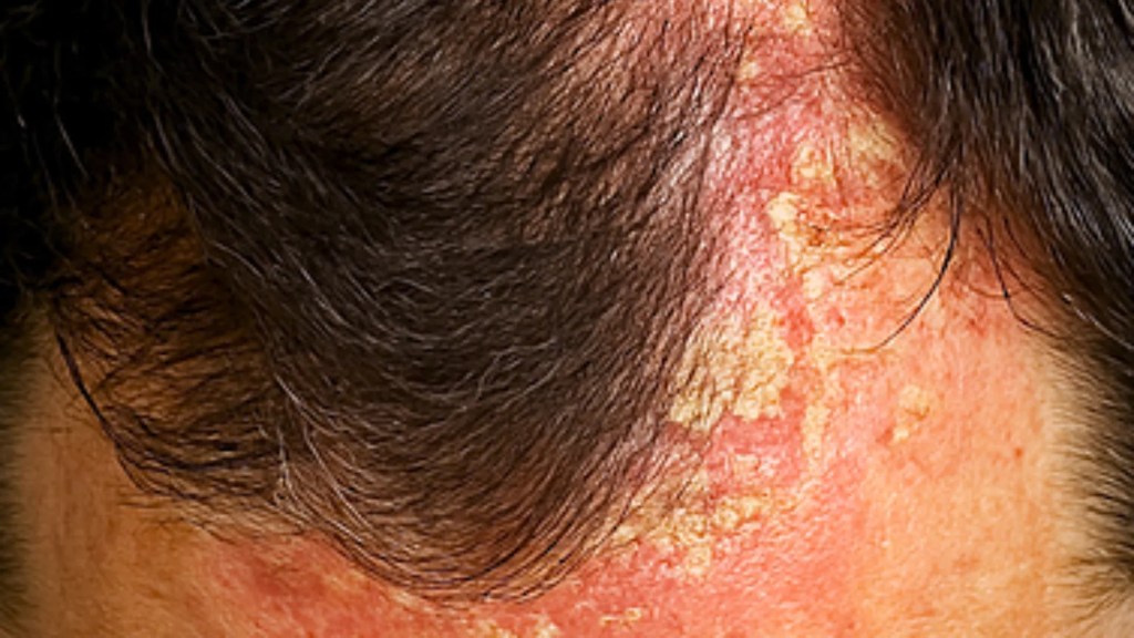 Dermatitis seborreica grave: cuero cabelludo.