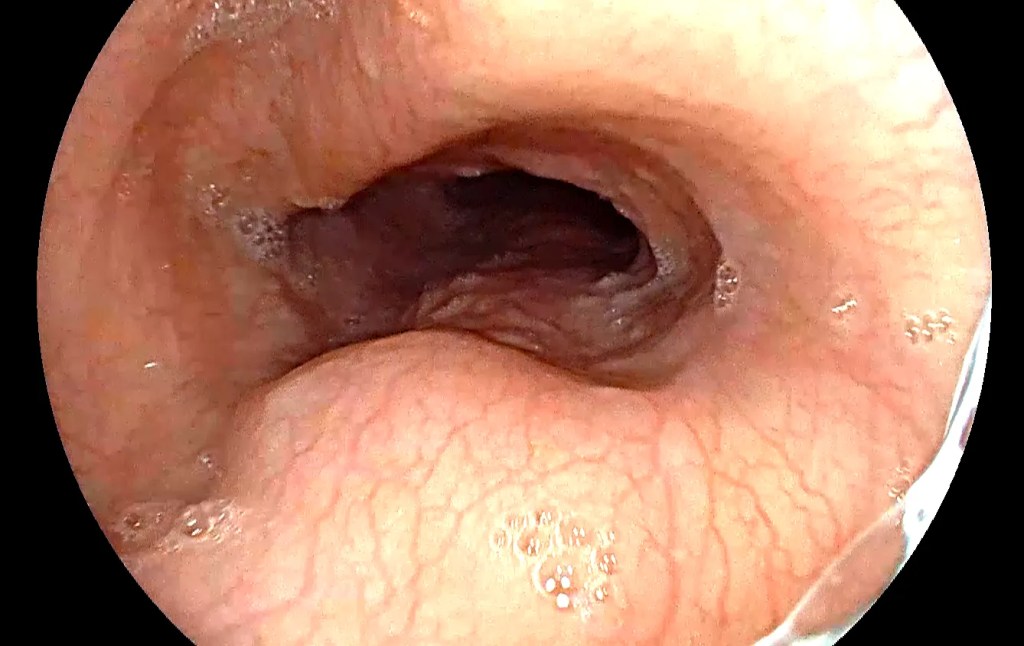 Esófago dilatado por acalasia