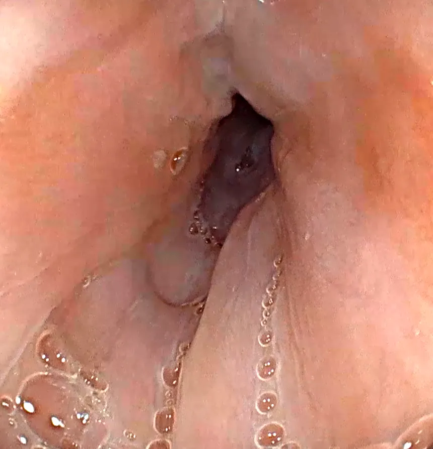 Acalasia.