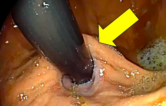 Funduplicatura Dor para una acalasia.