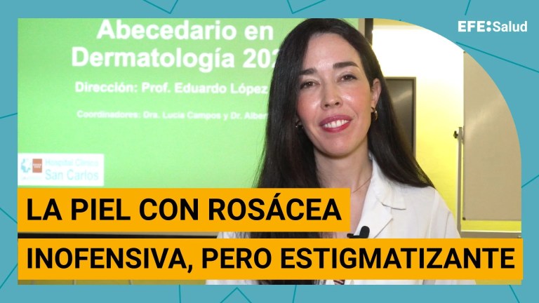 Rosácea