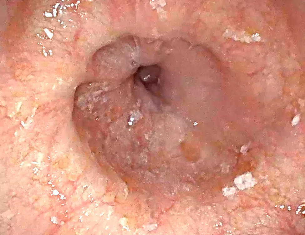 Acalasia