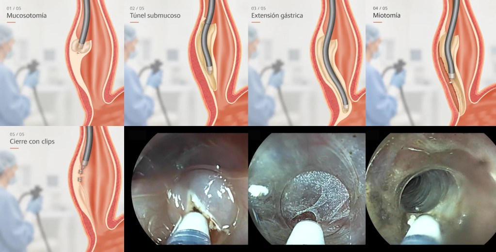 Tratamiento POEM en acalasia.