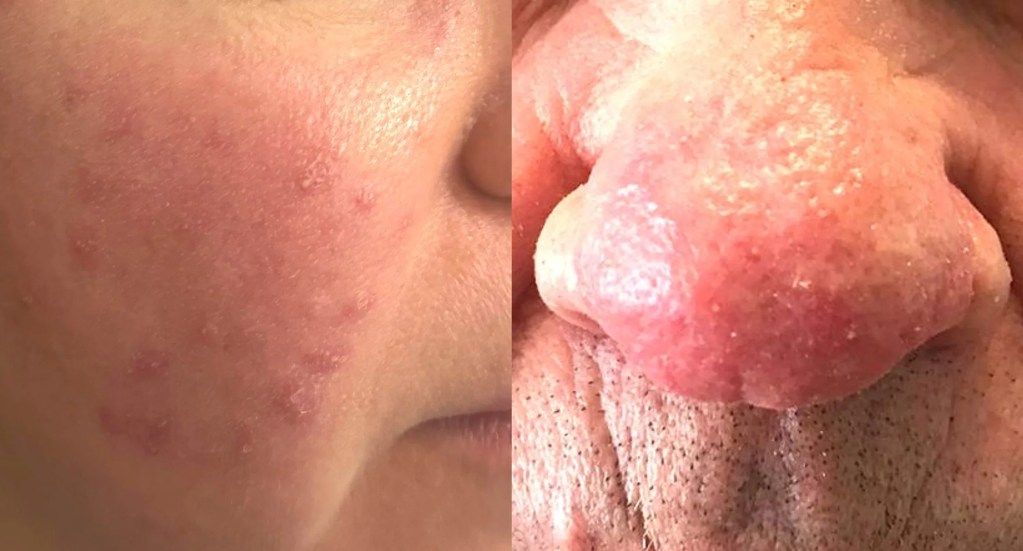 Rosácea facial.