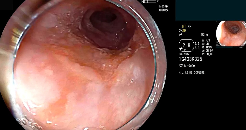 Acalasia.