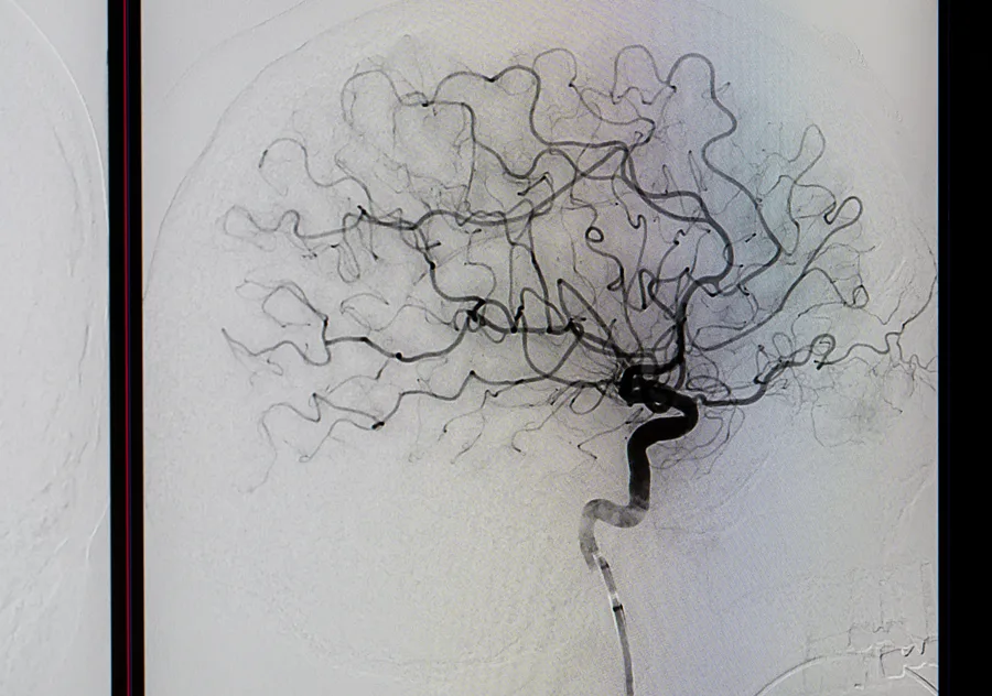 ictus consumo drogas 