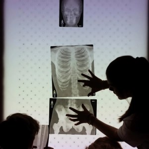 osteoporosis secundaria