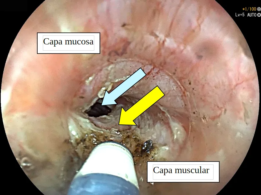 Técnica POEM en acalasia.
